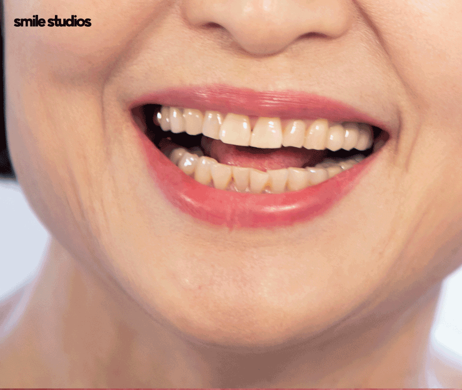 중년치아교정 소요 시간 포함 시작 전 체크할 사항 관련 이미지 8