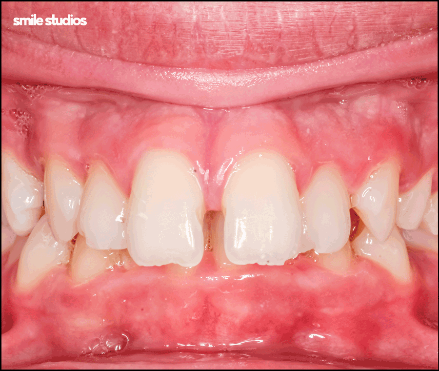 학동역치과 라미네이트 시작 전 확인해야 할 체크사항 관련 이미지 2