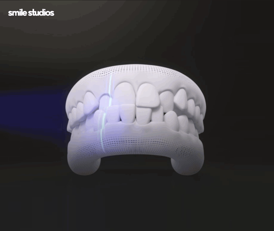 인비절라인 통증이 적은 결정적인 이유 알아보기 관련 이미지 7