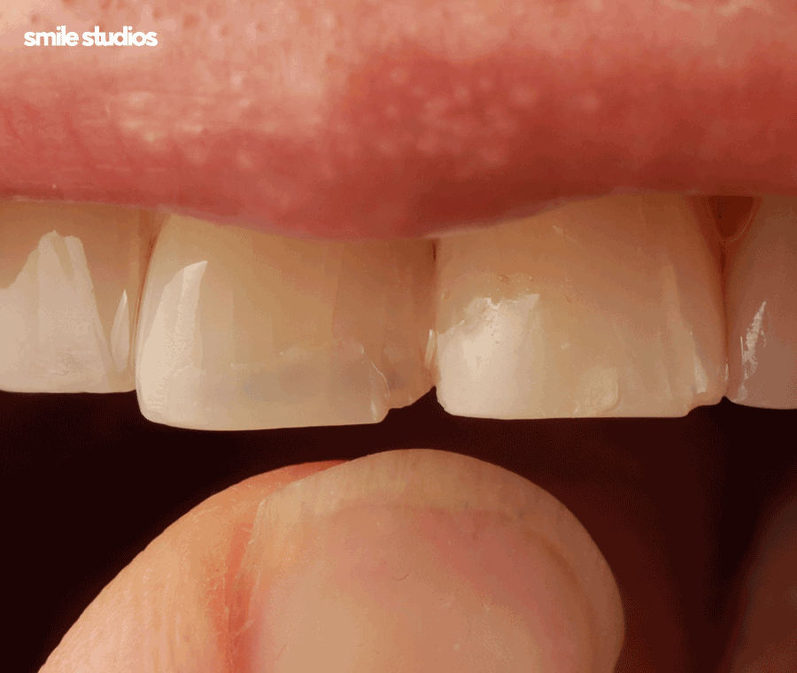 라미네이트제거 시기 및 유지력, 알아둘 사항 관련 이미지 4