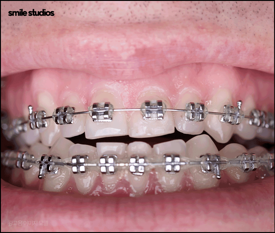 역삼역치과 인비절라인, 브라켓과 차이점 알아보기 관련 이미지 6