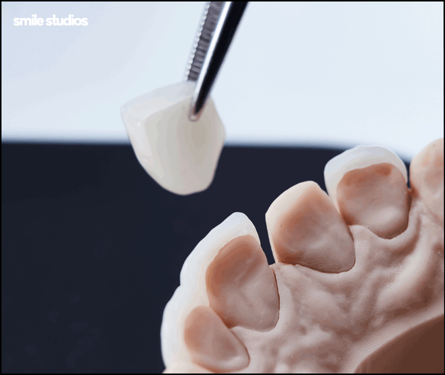 강남무삭제라미네이트 시작 전 확인할 핵심 포인트 관련 이미지 6