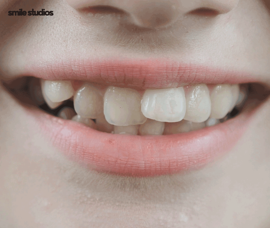 투명교정후기 알아본다면 함께 꼭 확인해야 할 2가지 관련 이미지 2