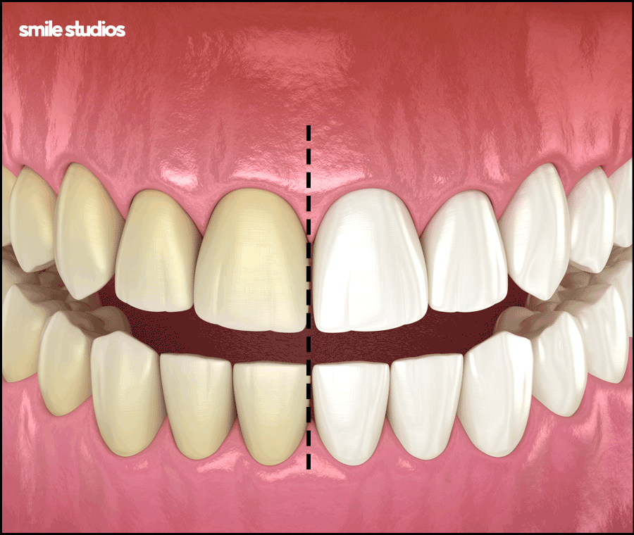 라미네이트 재시술 필요한 케이스, 주의사항 정리 관련 이미지 8