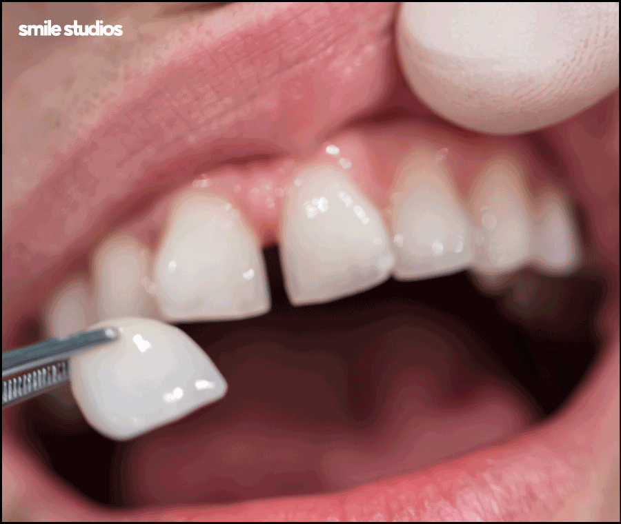 앞니 벌어짐 교정? 라미네이트? 케이스별 추천 방법 관련 이미지 9