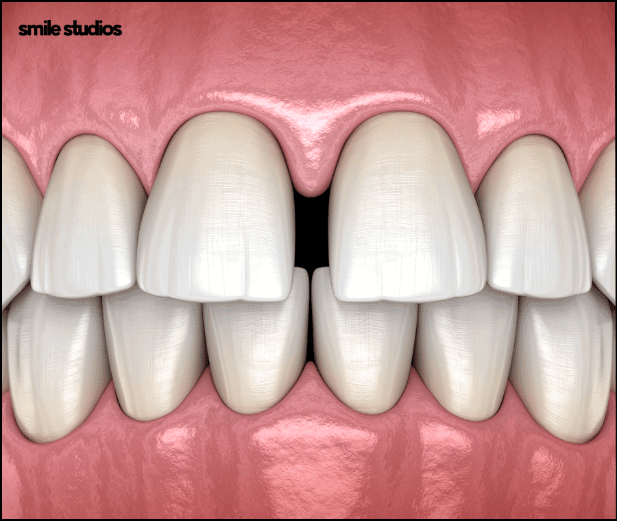 서울인비절라인 권장 케이스, 장점, 치료 시간 정리 관련 이미지 9