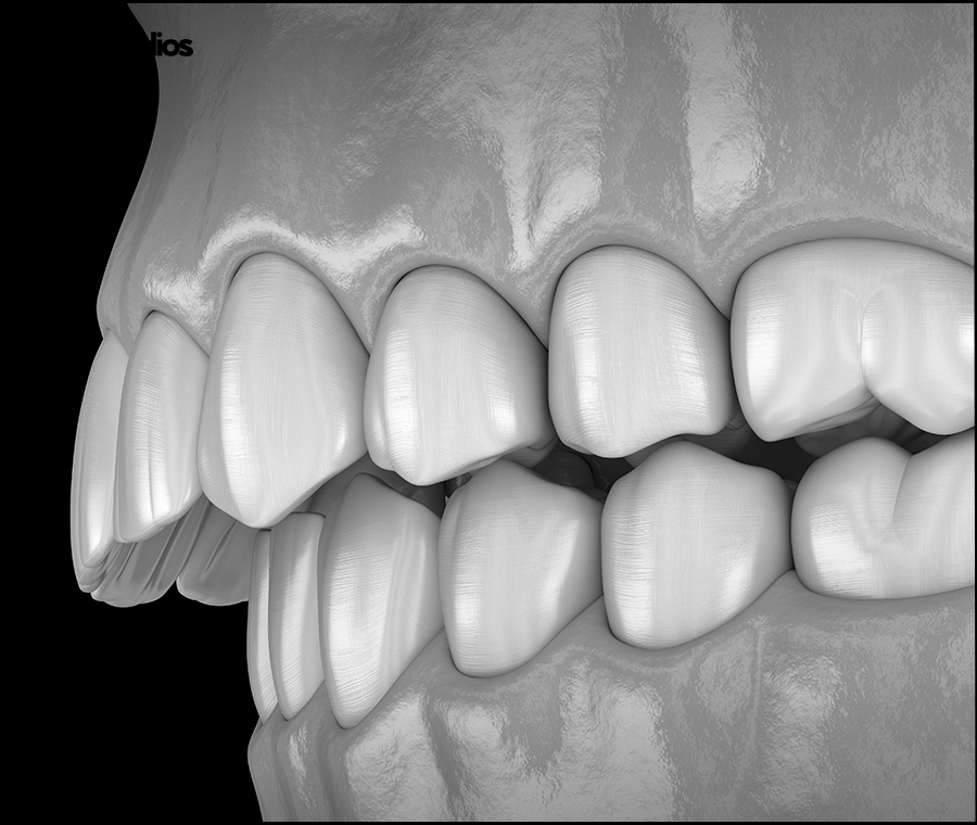 돌출입 인비절라인 기간, 과정, 개선 효과 관련 이미지 8