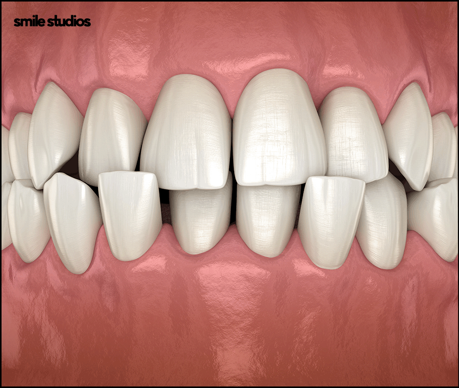 선정릉역치과 인비절라인 교정 전 필수 확인 사항 관련 이미지 5