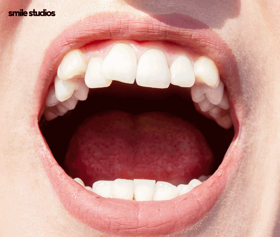 언주역 치과 치아교정 하려면 체크할 3가지 관련 이미지 9