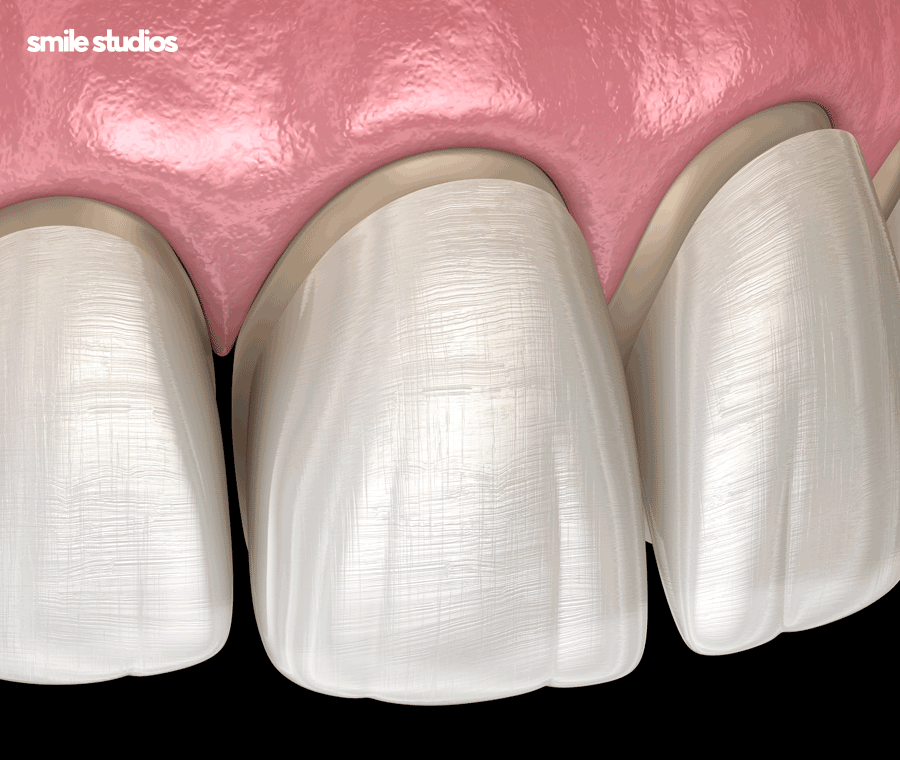 이빨깨짐 치료 치기를 놓치면 위험한 이유는? 관련 이미지 8