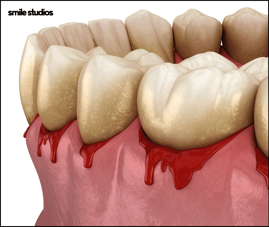 역삼역 치과, 치아 파임 증상 라미네이트 효과는? 관련 이미지 7