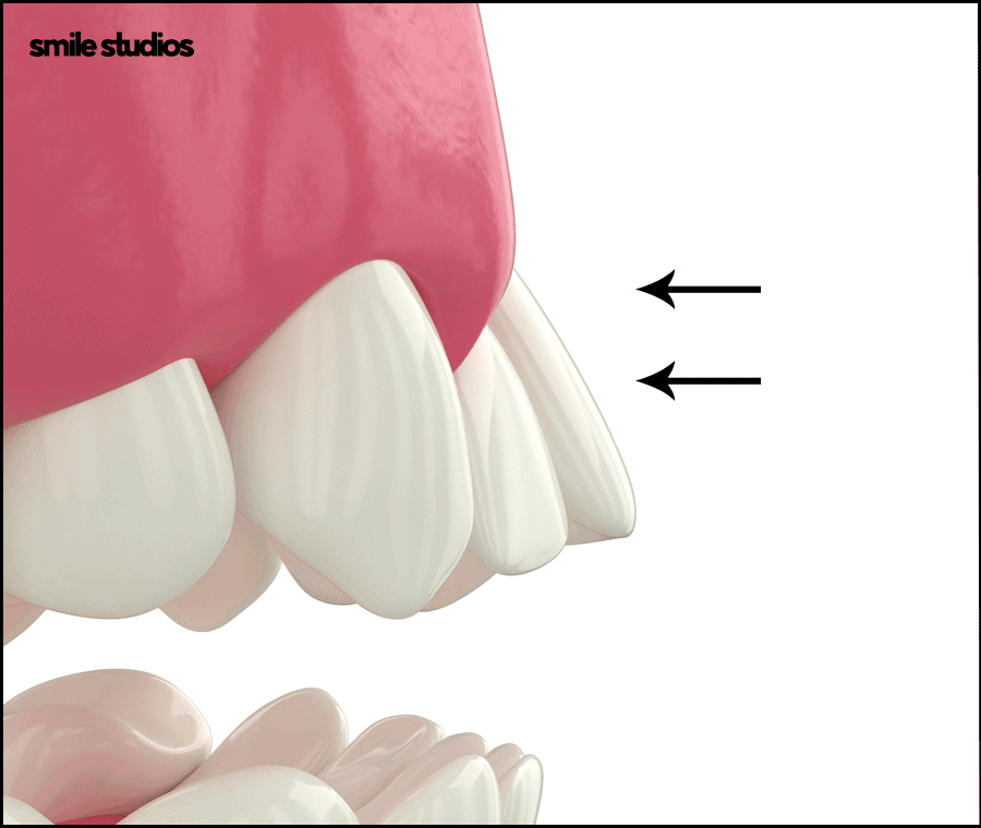 토끼이빨교정, 올바른 정렬을 위한 효과적인 방법은? 관련 이미지 7