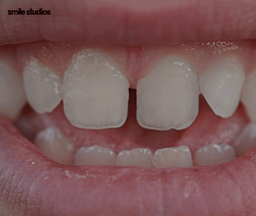 압구정 라미네이트 성공적인 결과를 만드는 핵심은? 관련 이미지 3