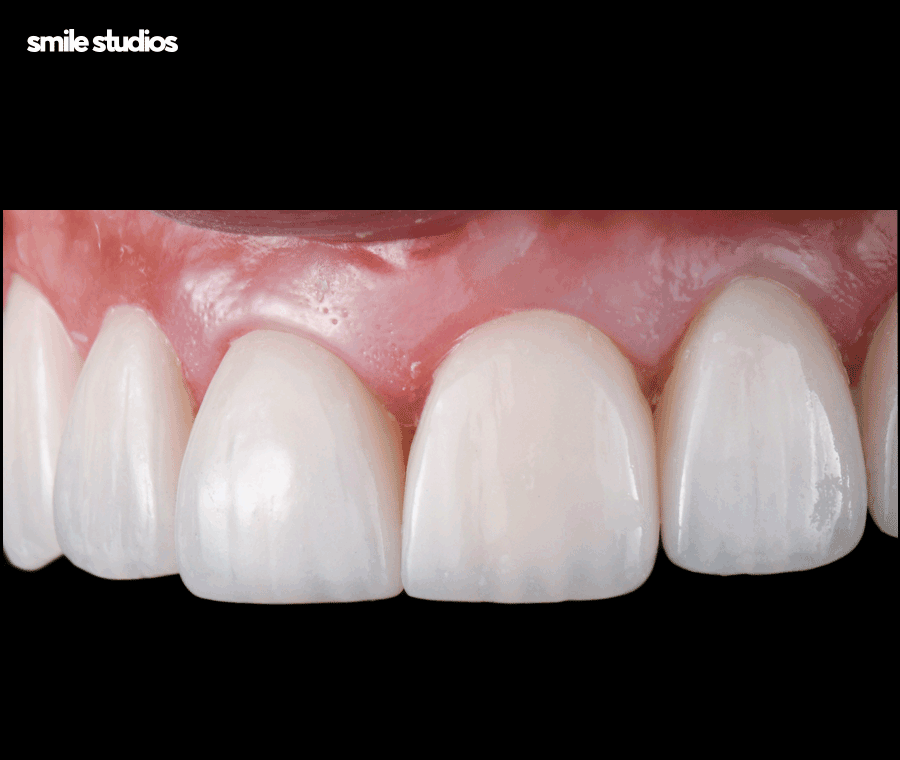 거미스마일 미소의 결함, 해결 방법 ft. 라미네이트 관련 이미지 7