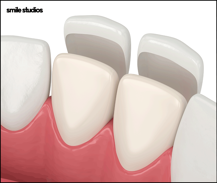 치과라미네이트 고른 치아 만들 때 핵심은? 관련 이미지 5
