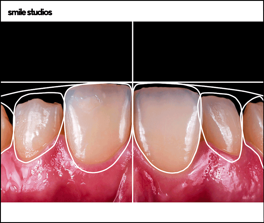 논현역 치과 라미네이트 시술 전 필수 확인 사항 관련 이미지 7
