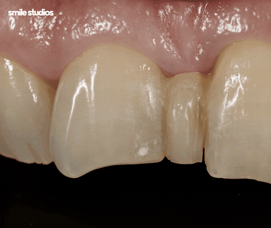 언주역 치과 치아교정 하려면 체크할 3가지 관련 이미지 8