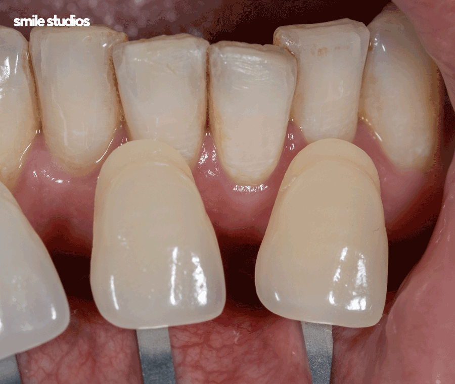 이빨사이벌어짐 부분 교정, 라미네이트 선택 Tip 관련 이미지 7