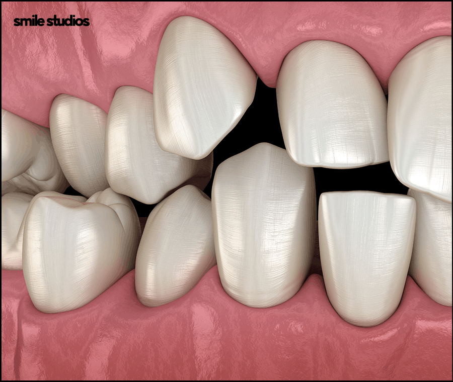 논현동 치과 인비절라인 투명교정 효과, 장/단점 관련 이미지 5