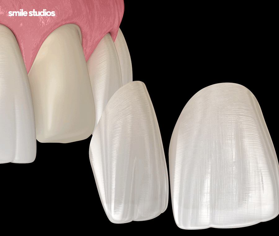 연예인 라미네이트 자연스러운 미소의 비밀은? 관련 이미지 5