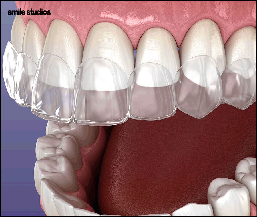 중년치아교정 소요 시간 포함 시작 전 체크할 사항 관련 이미지 4