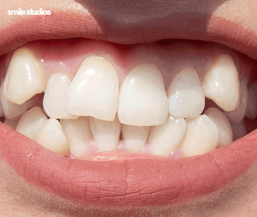 서울 논현동 치과 앞니 투명교정 장단점 총 정리 관련 이미지 2