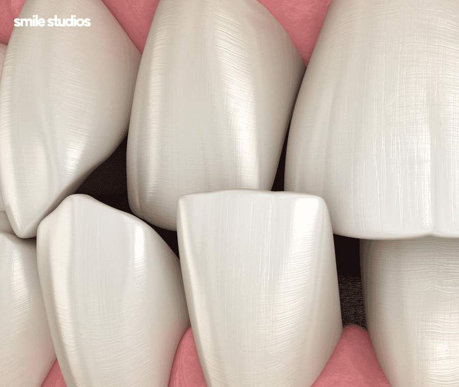 강남 논현 치과 투명 치아교정 시작 전 확인사항 관련 이미지 2