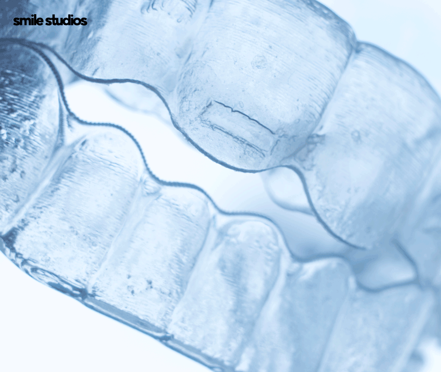 덧니교정 비용보다 중요하게 생각해야 하는 핵심 관련 이미지 7