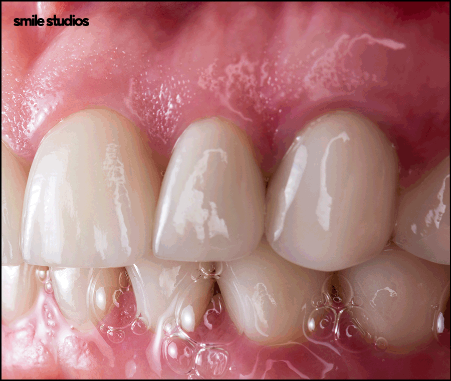 서울인비절라인 권장 케이스, 장점, 치료 시간 정리 관련 이미지 10