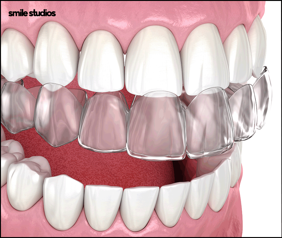 강남논현동치과 인비절라인 과정 및 개선 효과는? 관련 이미지 8