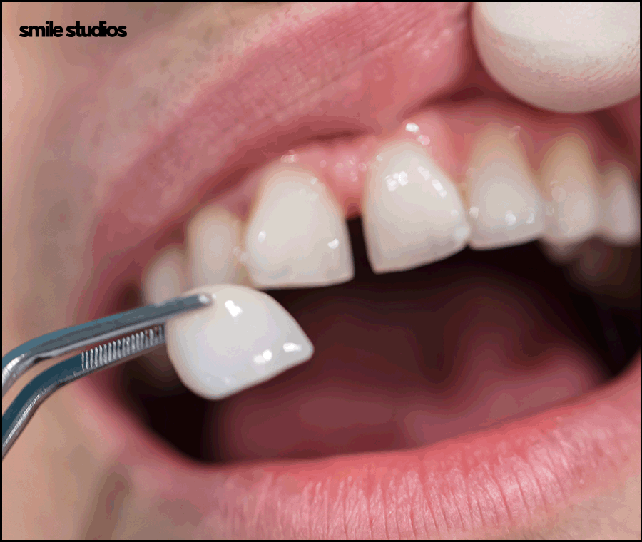 치아무삭제라미네이트 사실과 오해 알아보기 관련 이미지 3