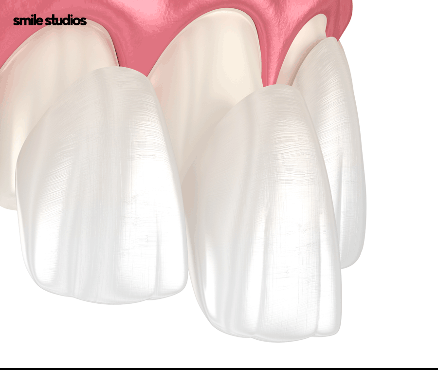 누런이빨 라미네이트 보완 효과, 미백과 차이점 관련 이미지 9