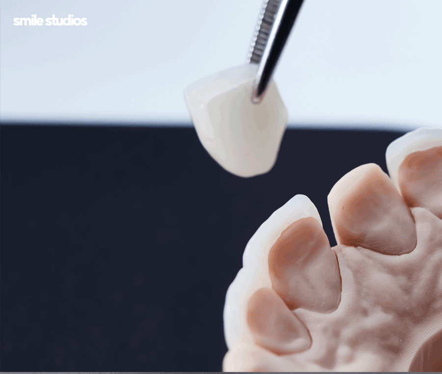 앞니깨짐 치료, 라미네이트 수복 여부, 효과 관련 이미지 8