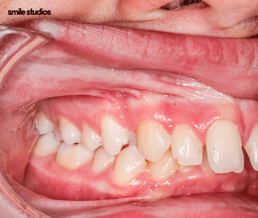 부정교합 치아교정 비용 다른 이유, 함께 체크할 사항 관련 이미지 2