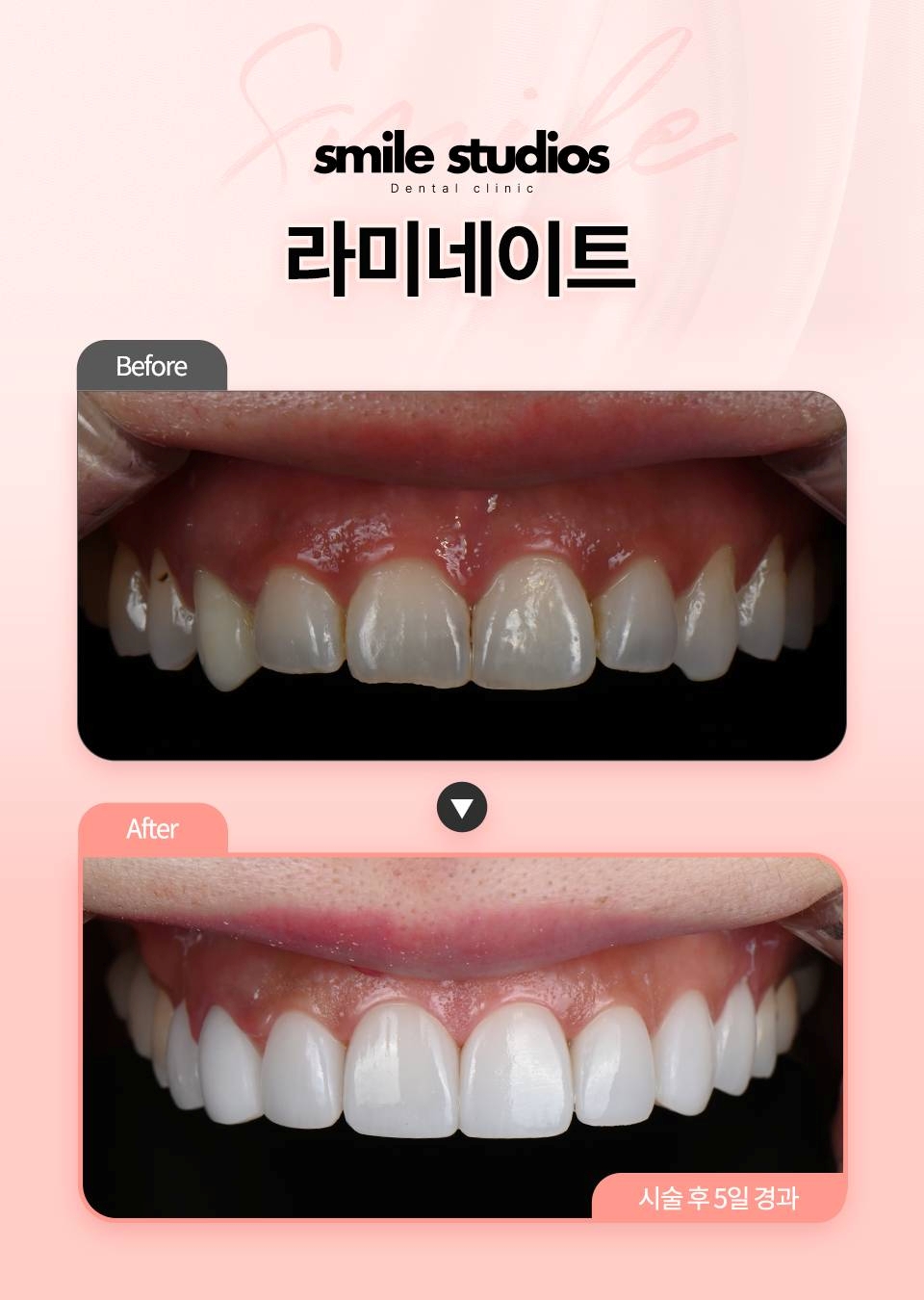 토끼이빨라미네이트, 시간 없다면 더 이상 고민 금지! 관련 이미지 3