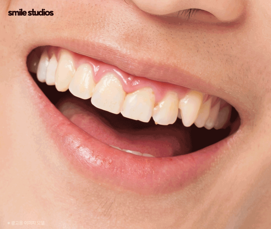 덧니교정 비용보다 중요하게 생각해야 하는 핵심 관련 이미지 9