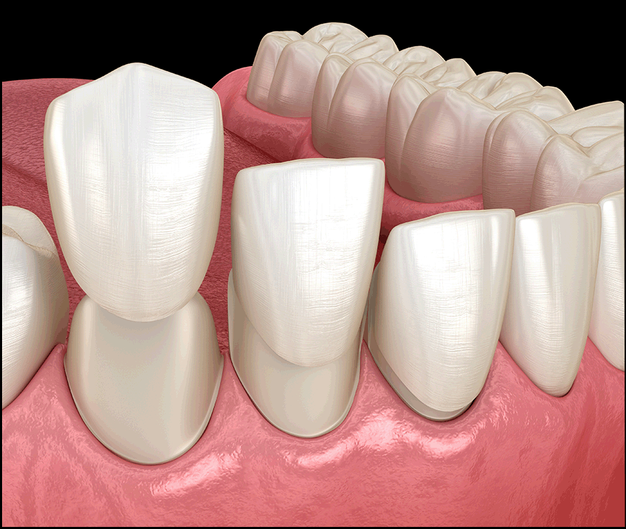 신논현역치과, 라미네이트 시술 전 꼭 확인할 핵심 2가지 관련 이미지 3