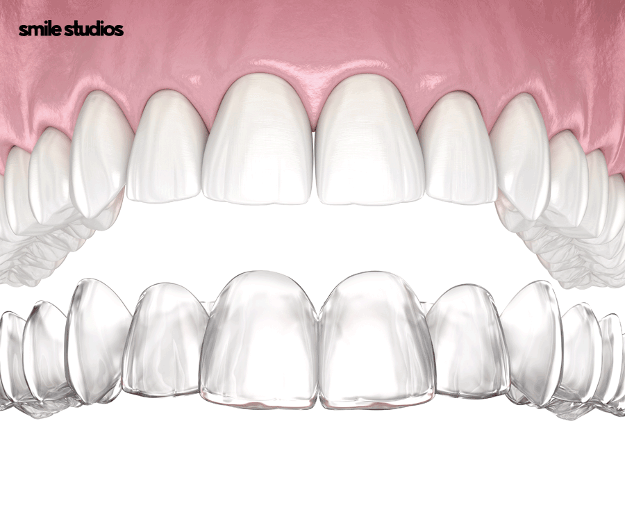 언주역 치과 치아교정 하려면 체크할 3가지 관련 이미지 7