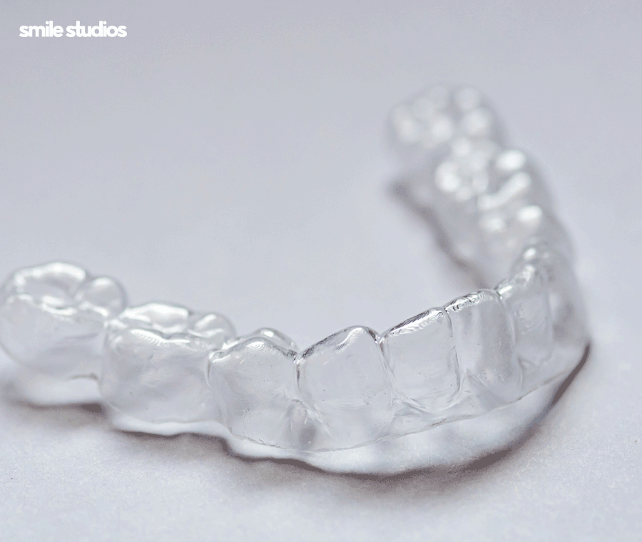 이빨사이벌어짐 부분 교정, 라미네이트 선택 Tip 관련 이미지 4