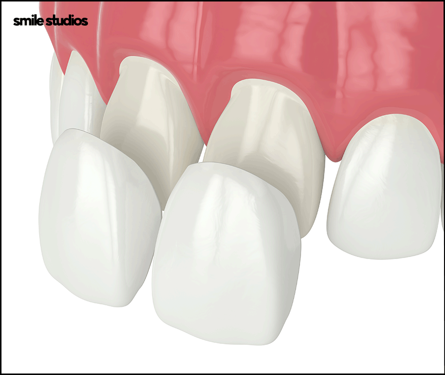 도산대로치과 앞니 라미네이트 크라운 차이점 관련 이미지 2