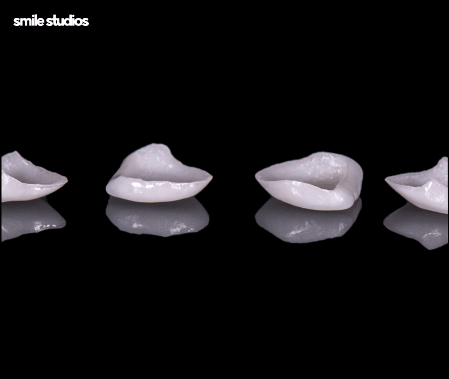 앞니부러짐 치아파절 대처 방법은? ft. 라미네이트 관련 이미지 7