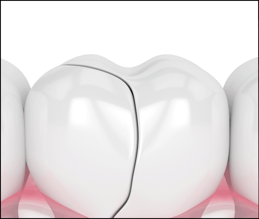 라미네이트 깨짐 대처, 어떻게 해야할까요? 방법 정리 관련 이미지 3