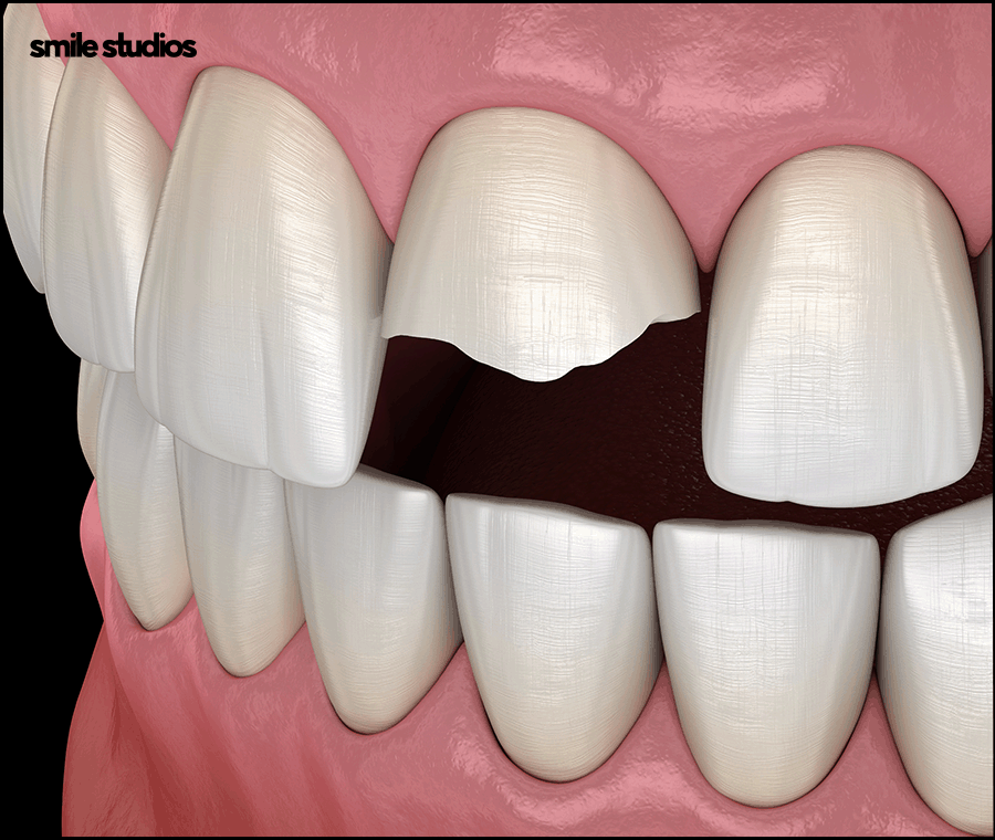 앞니부러짐 치아파절 대처 방법은? ft. 라미네이트 관련 이미지 2