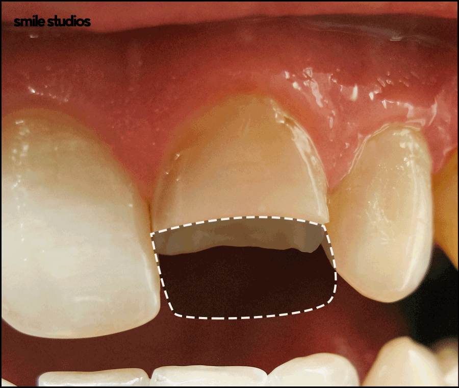 How to Restore Chipped or Fractured Front Teeth and Check the Results image 3