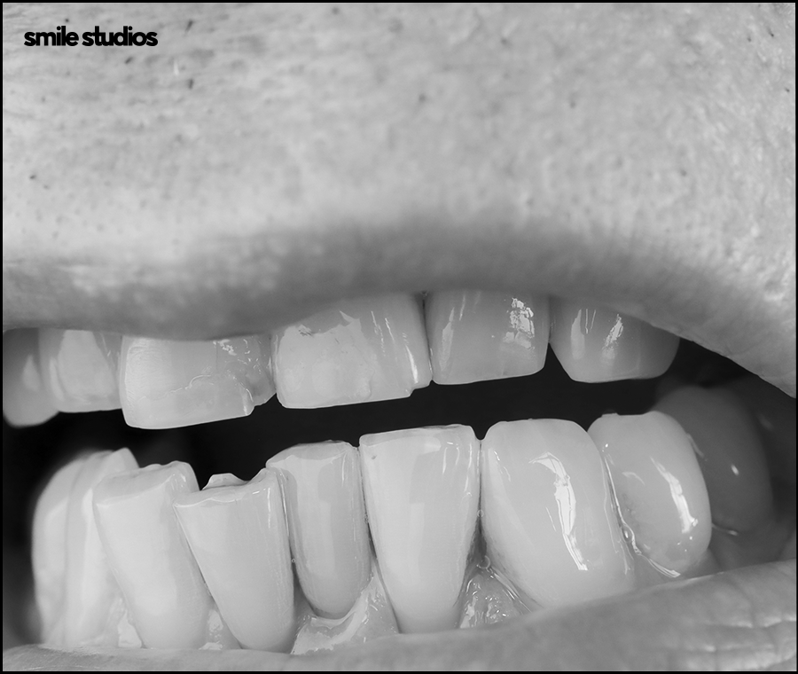 Invisalign Cost, Treatment Duration, and Pre-Treatment Checklist image 8