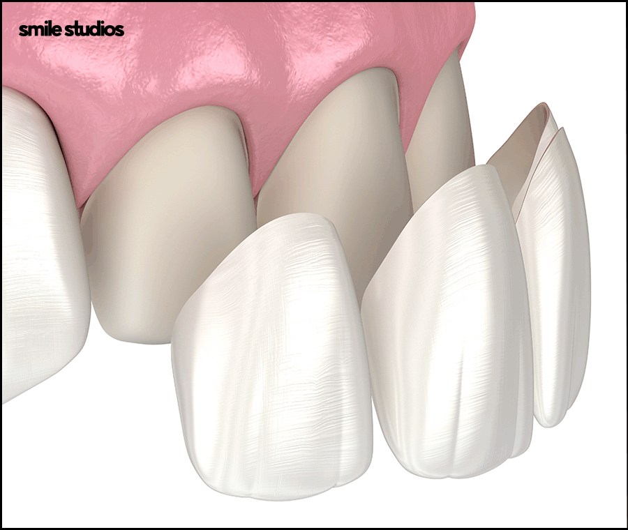 신사동치과 라미네이트 수명 늘리는 방법 A to Z 관련 이미지 2