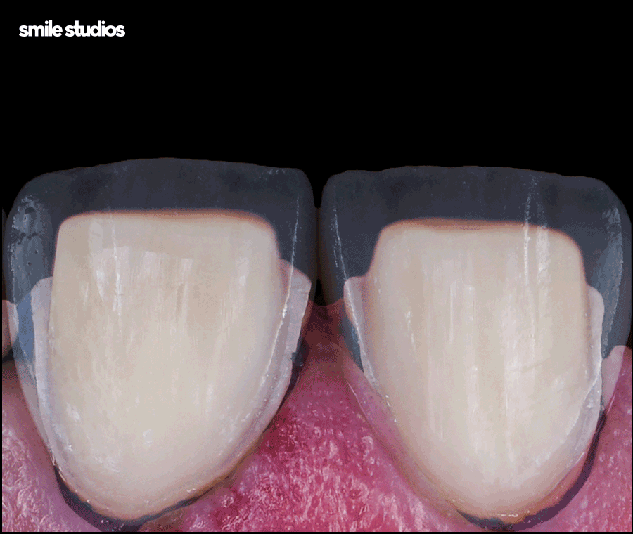 왜소치라미네이트 심미성 개선 효과, 필요성 관련 이미지 10