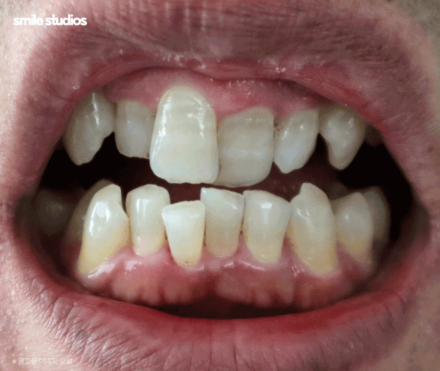 이빨교정비용 좌우하는 기준점 알아보기 관련 이미지 4