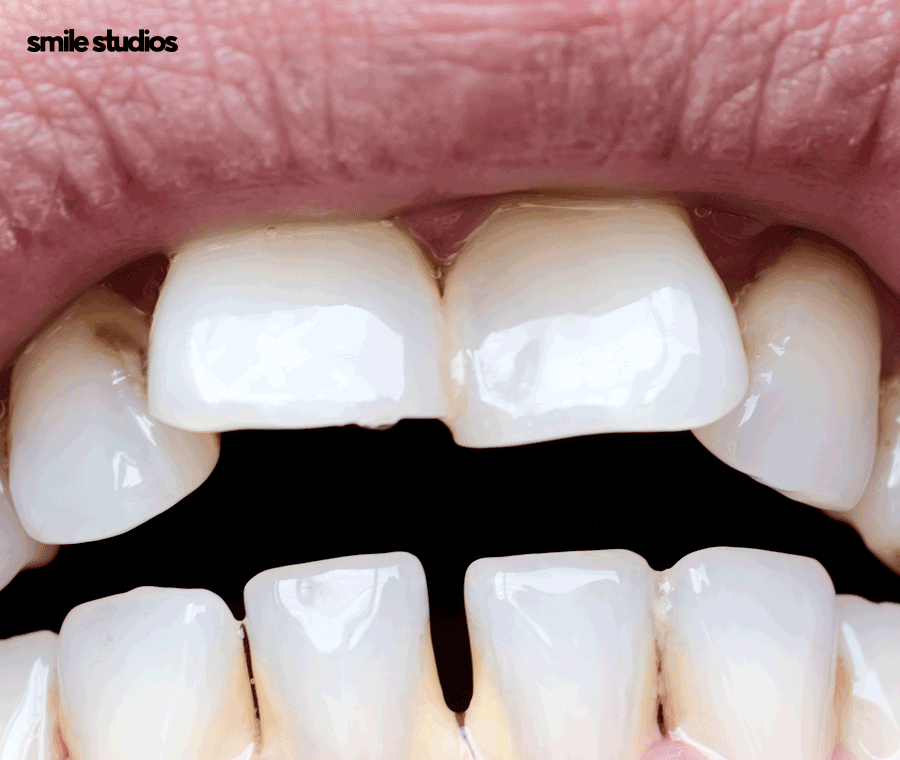 강남역 교정치과 삐뚠 앞니, 부분 치료 괜찮을까? 관련 이미지 3