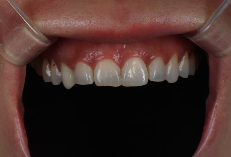 신사역치과 라미네이트 후 이미지 변화? 자연스러움의 비밀 공개! 관련 이미지 8